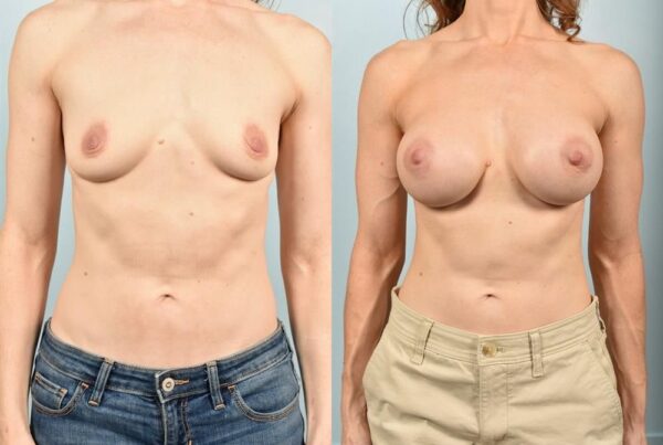 Sub-Fascial Breast Augmentation 4