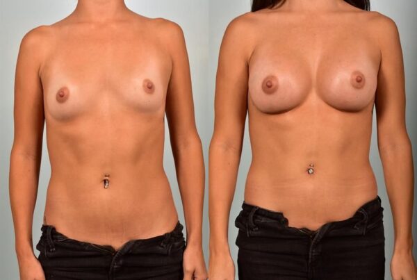 Sub-Fascial Breast Augmentation 5
