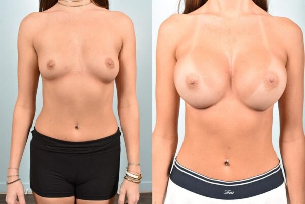 Sub-Fascial Breast Augmentation 9