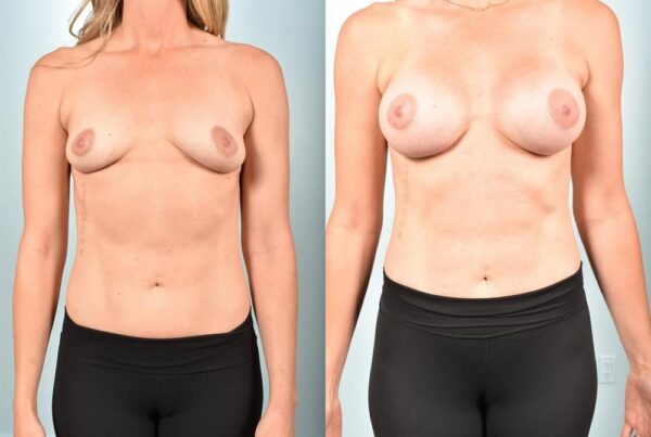 Sub-Fascial Breast Revision 1