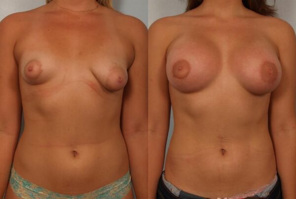 Tuberous Breast Surgery 1