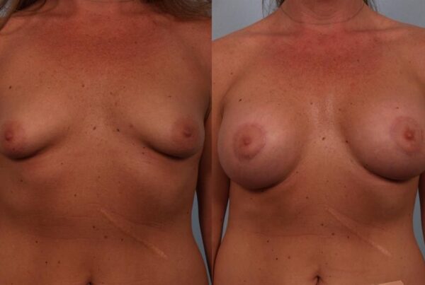 Tuberous Breast Surgery 2