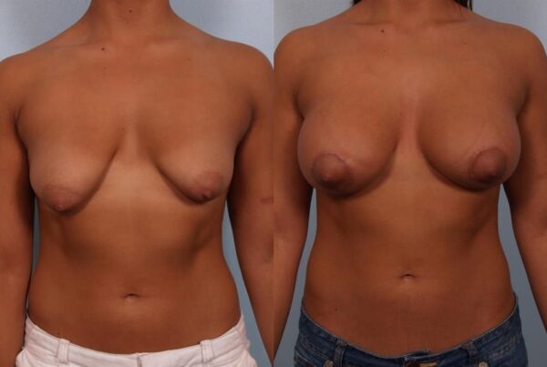 Tuberous Breast Surgery 3