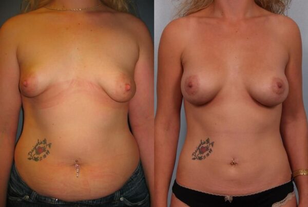 Tuberous Breast Surgery 4