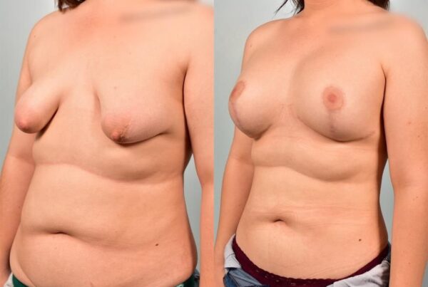 Tuberous Breast Surgery 5