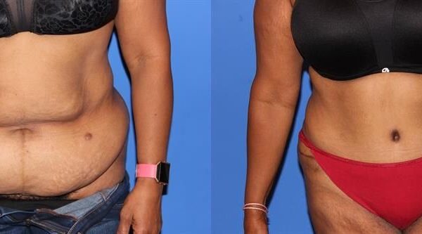 Tummy Tuck 1