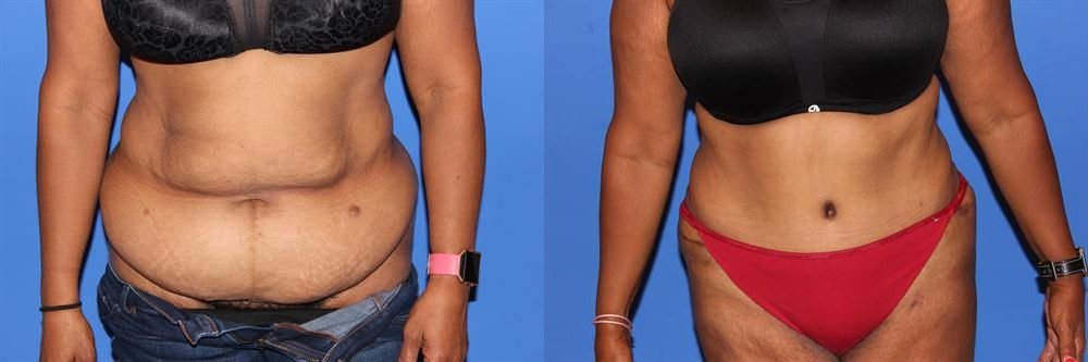 Tummy Tuck 1