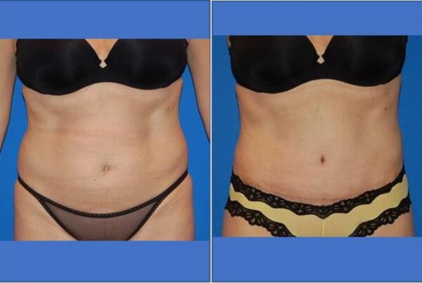 Tummy Tuck 10