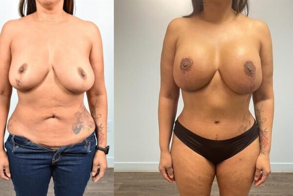 Tummy Tuck 12
