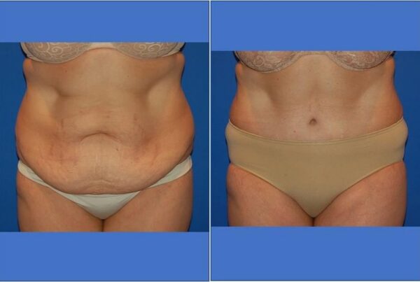 Tummy Tuck 13
