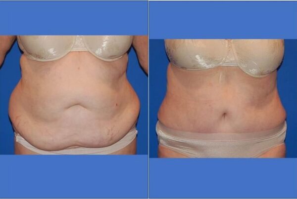 Tummy Tuck 15