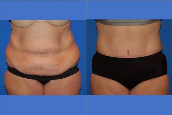 Tummy Tuck 16