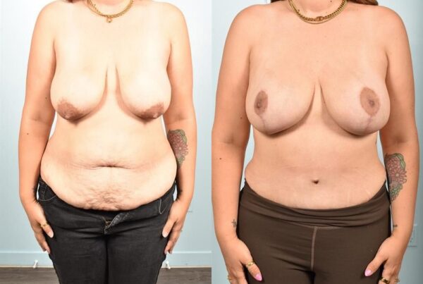 Tummy Tuck 2