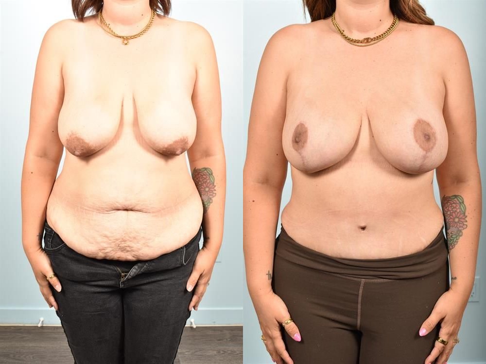 Tummy Tuck 2