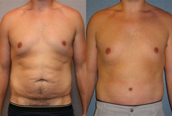 Tummy Tuck 3