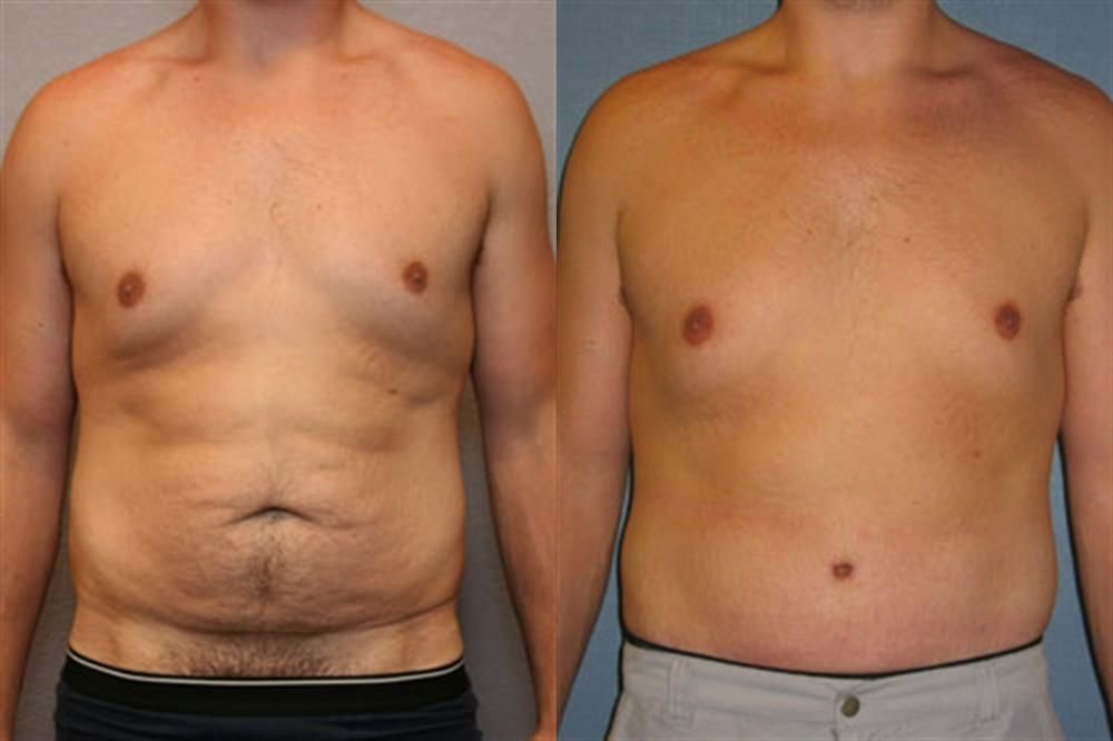 Tummy Tuck 3