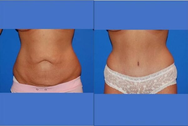 Tummy Tuck 4