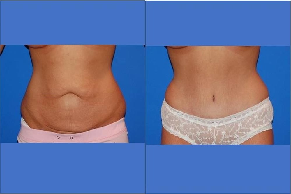 Tummy Tuck 4