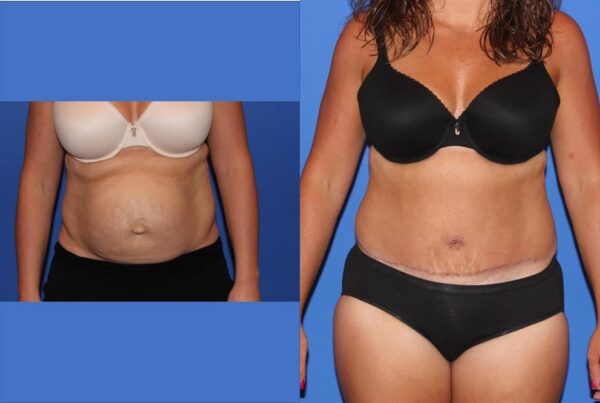 Tummy Tuck 5