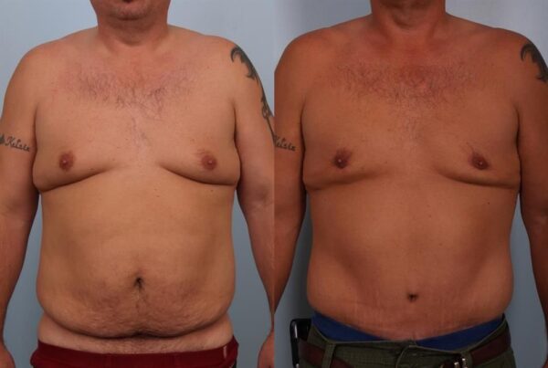 Tummy Tuck 6