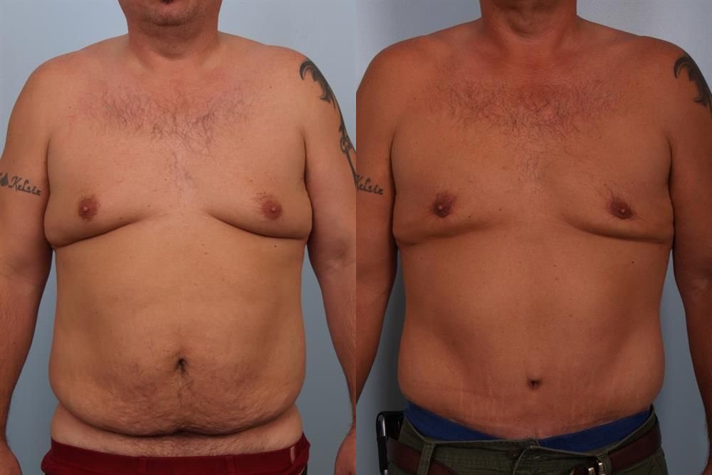 Tummy Tuck 6
