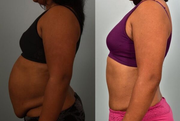 Tummy Tuck 7