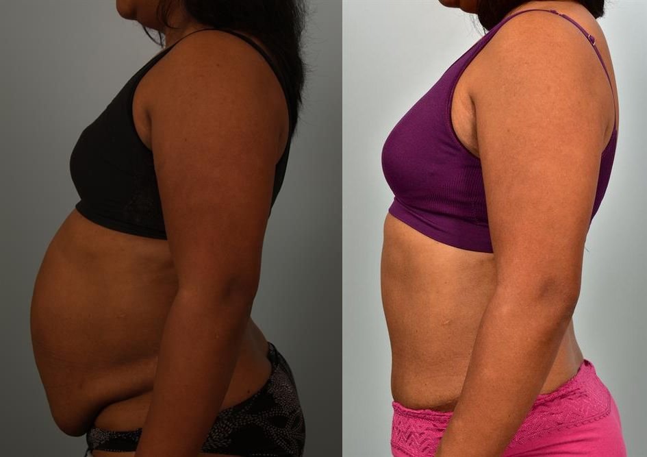 Tummy Tuck 7
