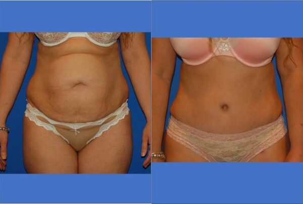 Tummy Tuck 8