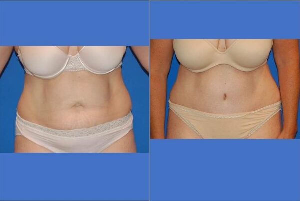 Tummy Tuck 9